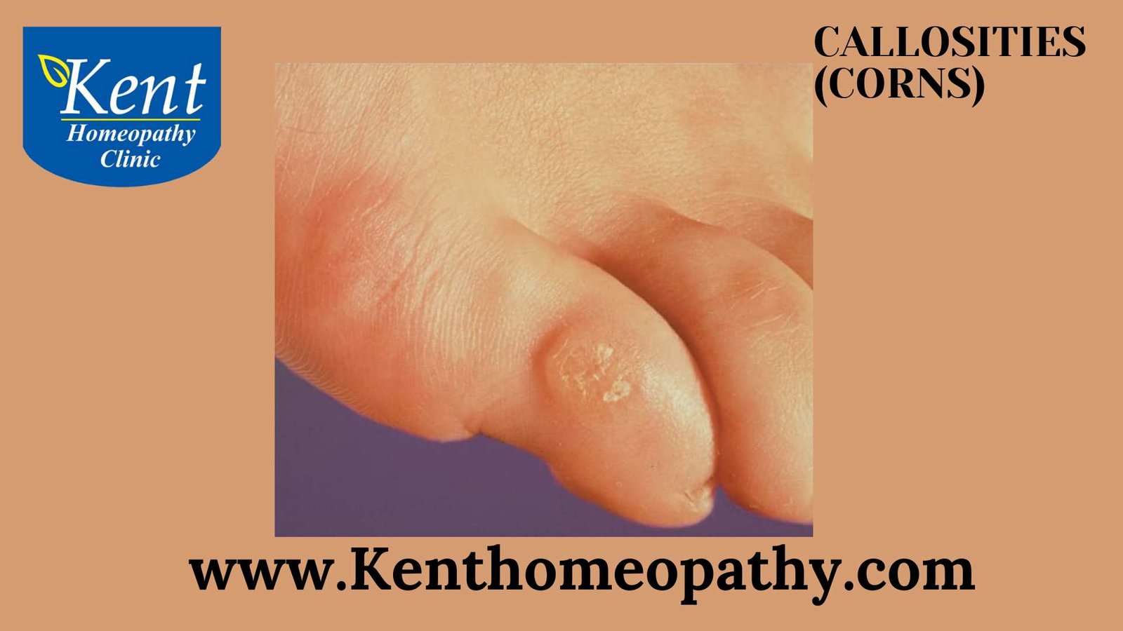 Callosities corns Kenthomoepathy Powai Mumbai Homeopathy Doctor Homeopathic Treatment Medicine Powai Mumbai