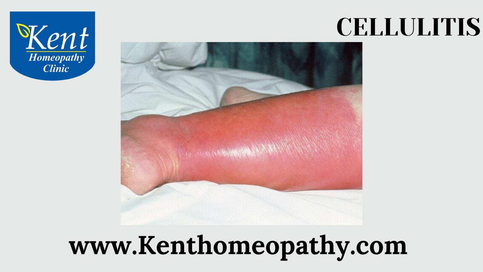 Cellulitis Kenthomoepathy Powai Mumbai Homeopathy Doctor 