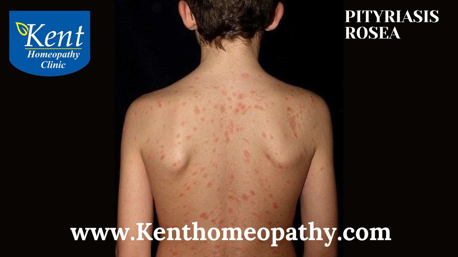 Pityriasis Rosea Kenthomoepathy Powai Mumbai Homeopathy Doctor 