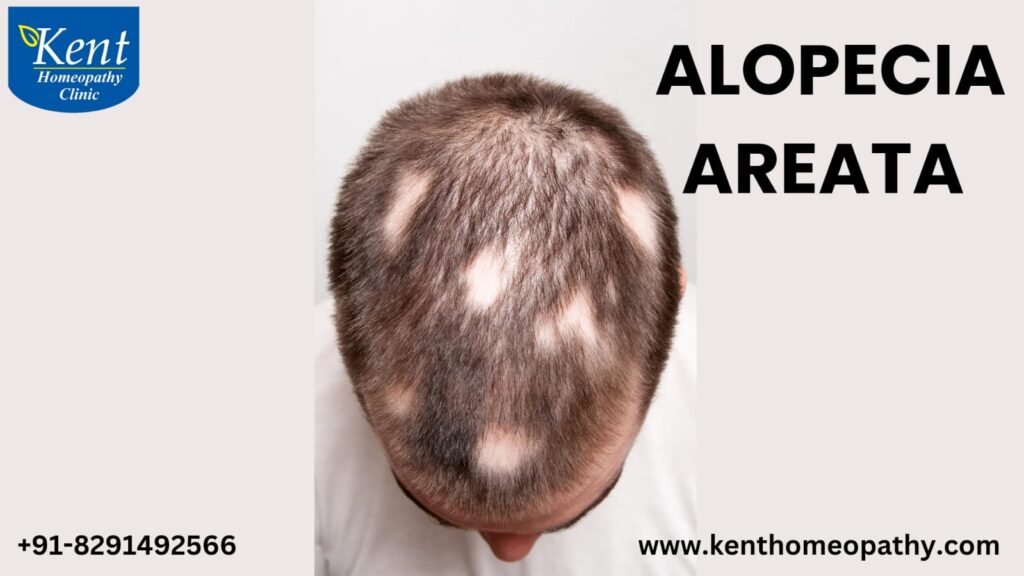 Alopecia Areata